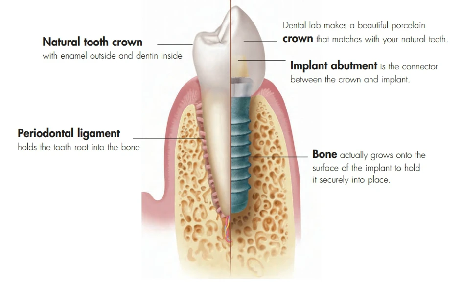 illustration of a natural tooth vs dental implant