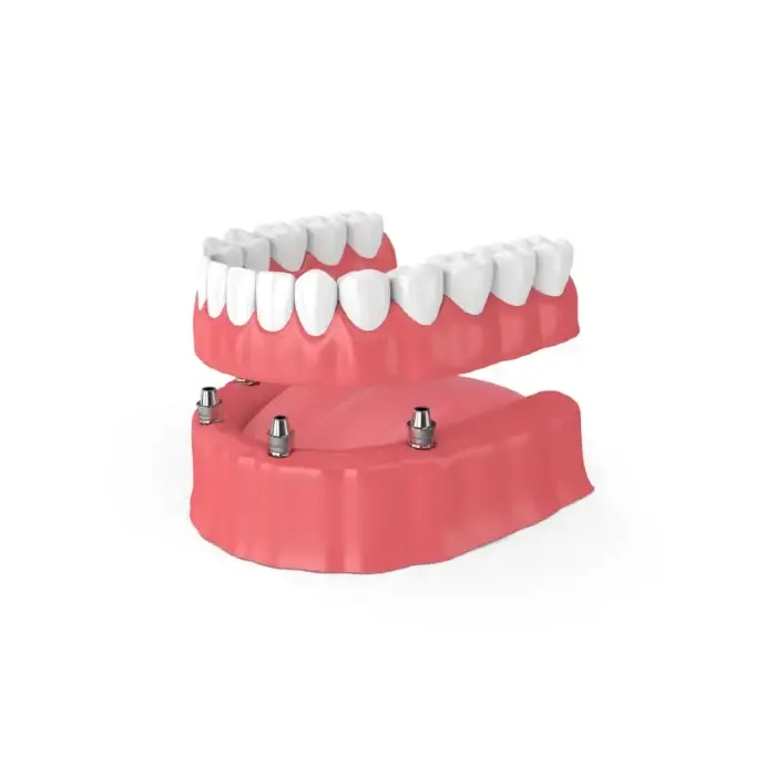 snap-in implant dentures Eugene, OR