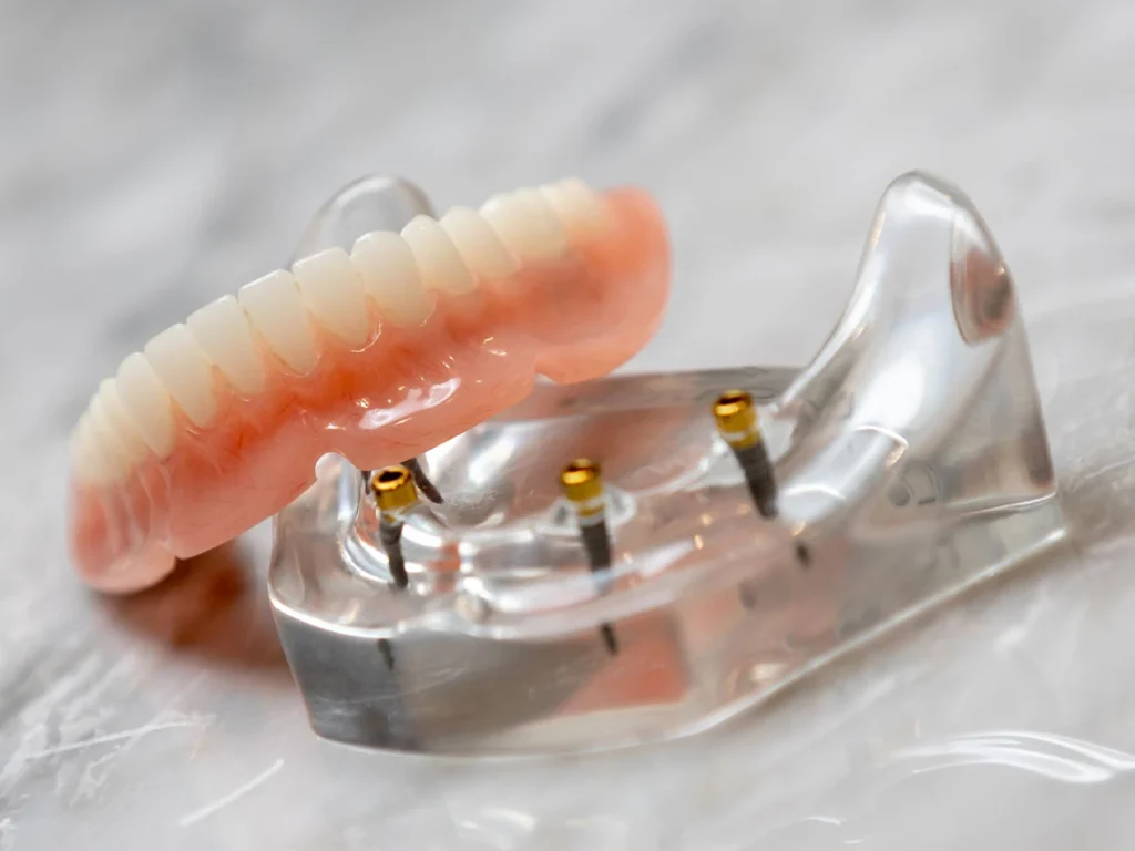 lower 4-implant snap-in implant denture unsnapped